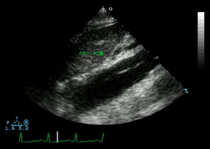 Fetal Cardiology: Congenital Heart Disease Of The Right Heart image