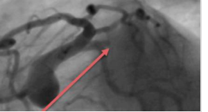 Total Occlusion Late After Myocardial Infarction image