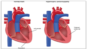Hypertrophic Cardiomyopathy Top 10 image