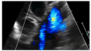 The Pulmonic Valve And Artery image