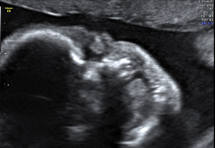 Ultrasound Artifacts 4: Normal Anatomic Variants & Aortic Dissection image