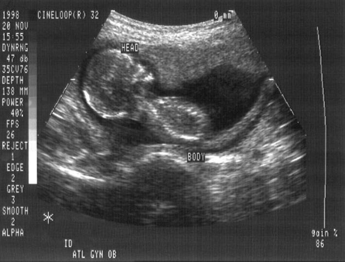 Ultrasound of in utero human fetus