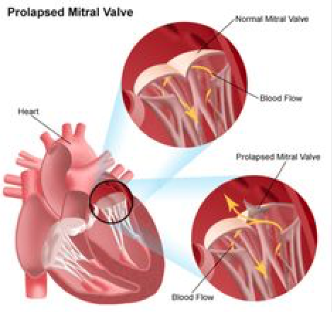Mitral Valve 4: Mitral Valve Surgery image