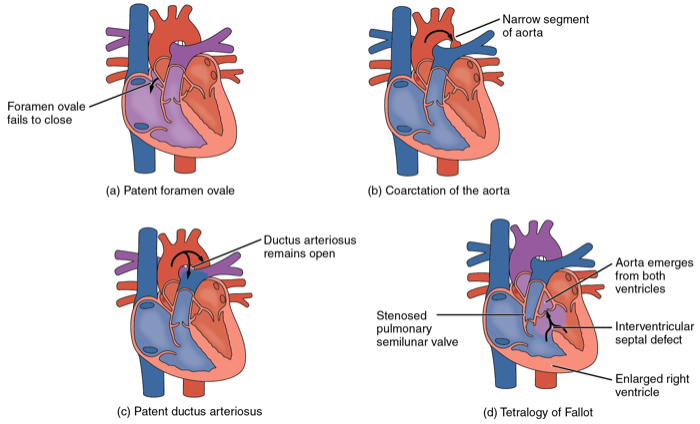 Critical Congenital Heart Disease, Part 2 image