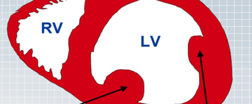 Mechanical Complications Of MI: Papillary Muscle Rupture, Free Wall Rupture, Ventricular  image