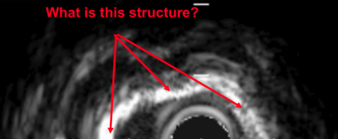 Intravascular Ultrasound image