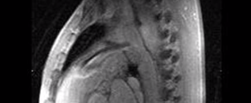 Left To Right Shunts: Patent Ductus Arteriosus (PDA) image