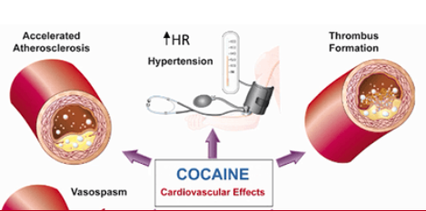 Cocaine-Associated ST-Elevation Myocardial Infarction image