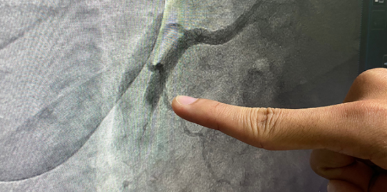 Coronary Angiography: Views and Pitfalls image