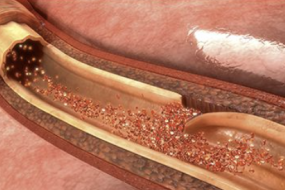 Cutaway view of an artery