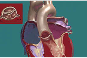 Bicuspid Aortic Valve And Pulmonic Stenosis image