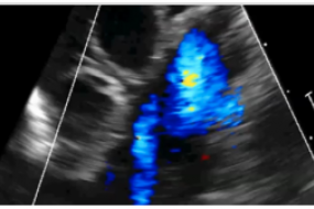 The Pulmonic Valve And Artery image