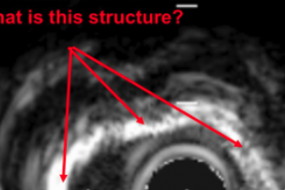 Intravascular Ultrasound image