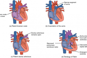 Congenital Heart Disease In Adults 3: Complex Defects image