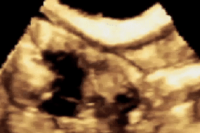 3D Ultrasound image